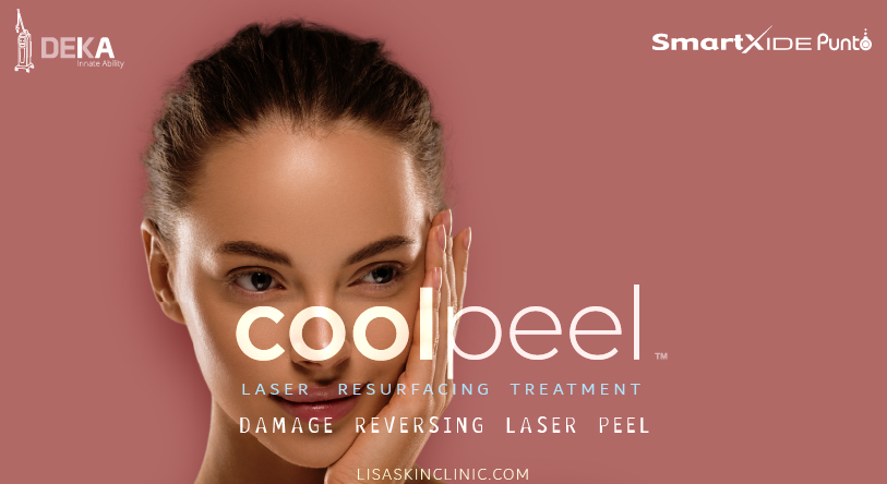 the best ever laser cool peel with smart Xide PUNTO from Deka Laser at Lisa Skin Clinic , Kozhikode, Kerala, India. Damage reversing Laser Skin peel using Laser resurfacing treatments combined with EXOSOME therapy for Skin by Dr Jenny Mathew