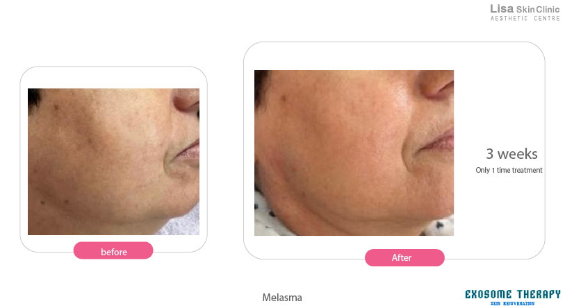 Lisa skin clinic, Calicut, Fillers