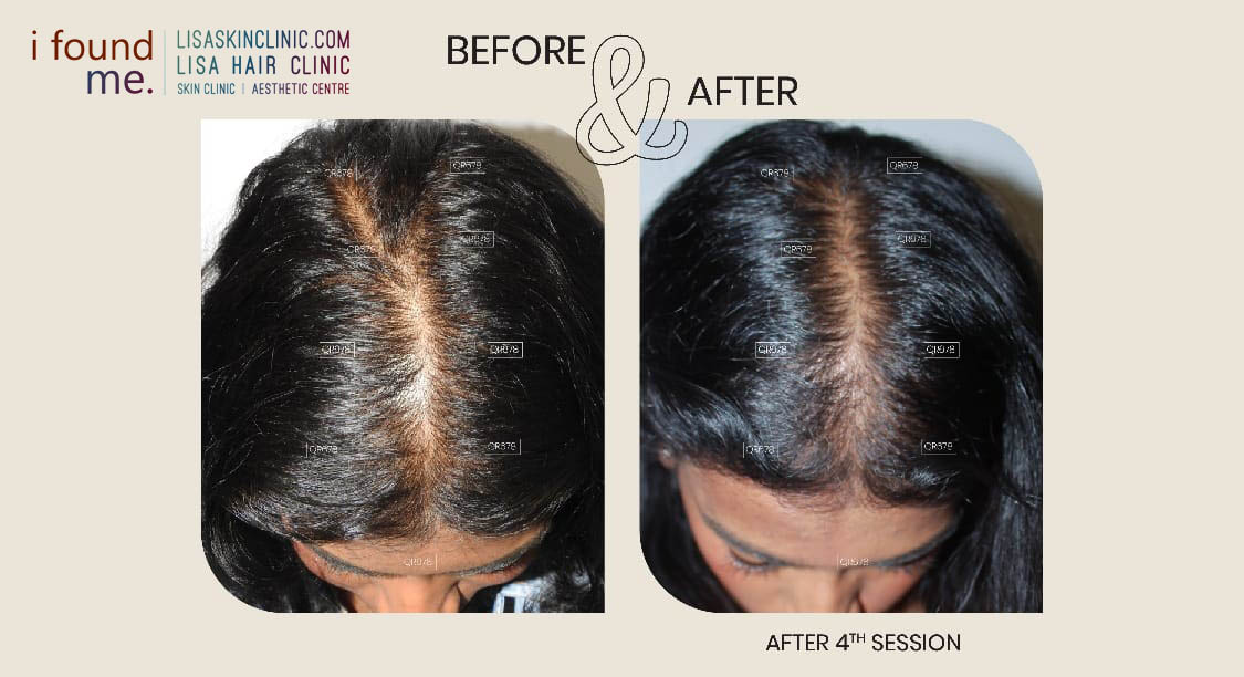 Best Hair Clinic in Calicut for Hair Rejuvenation with QR678