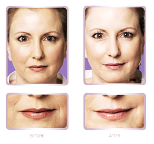 Lisa skin clinic, Calicut, Fillers