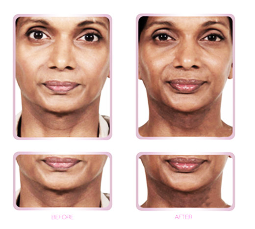 Lisa skin clinic, Calicut, Fillers