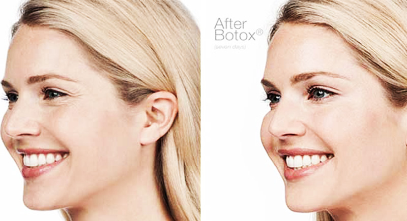 Lisa skin clinic, Calicut,Botox treatment