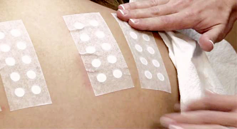 Lisa skin clinic, Calicut,Patch Testing