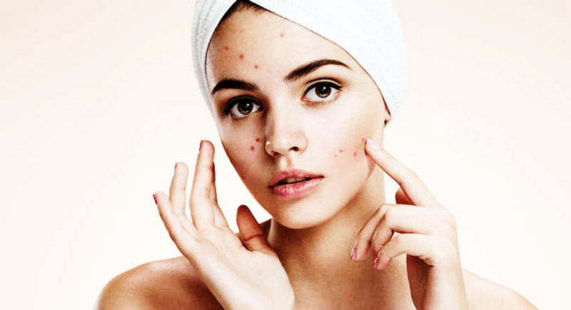 Lisa skin clinic, Calicut,Pimple treatment,Acne treatment