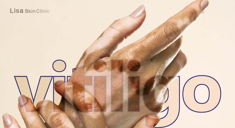 Lisa Skin Clinic,Vitiligo-clinic