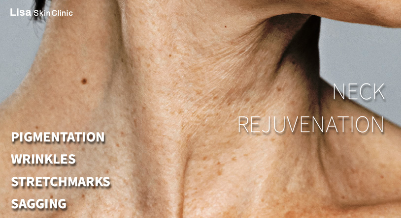 Lisa Skin Clinic,Calicut,neck-rejuvenation
